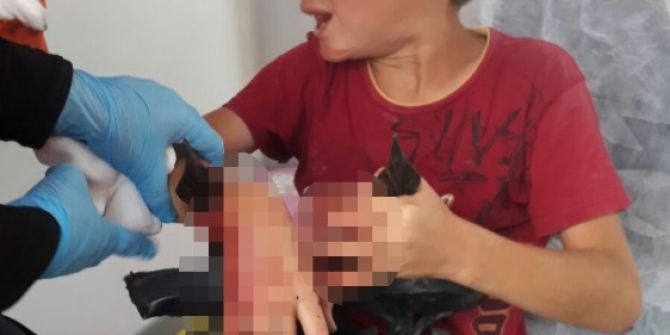 Küçük Çocuğun Koluna Demir Saplandı