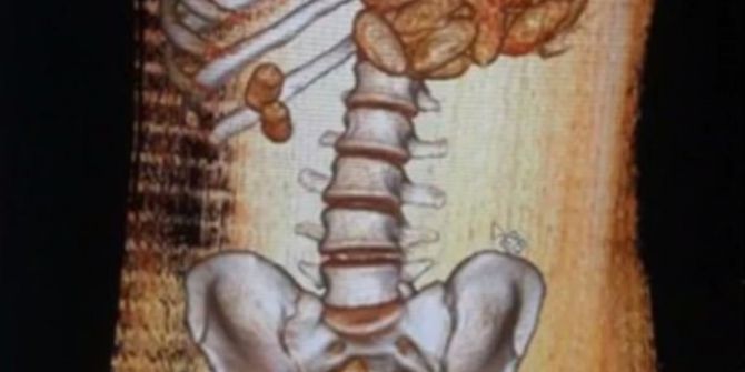 Nijeryalı Kuryenin Midesinden 1 Kilo 80 Gram Kokain Çıktı