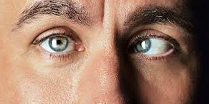 Şaşılık İhmale Gelmez