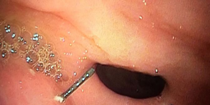 Petek Bal Yedi, Midesinden 10 Santim Tel Çıktı