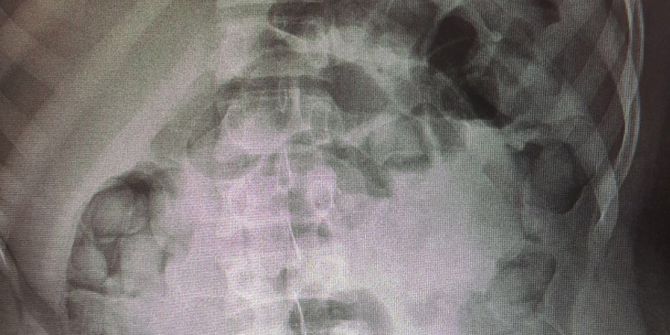 İranlı Kuryenin Midesinden Eroin Çıktı