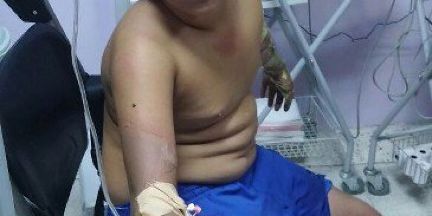 Çakmak Gazı Patlayınca 3 Çocuk Yaralandı