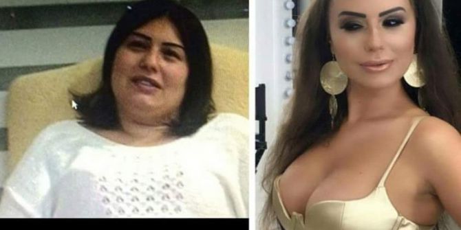 Güzellik uğruna 17 kez bıçak altına yatıp 100 bin lira harcadı