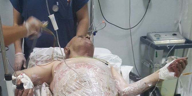 Sigaradan elbiseleri tutuştu, yanarak ağır yaralandı