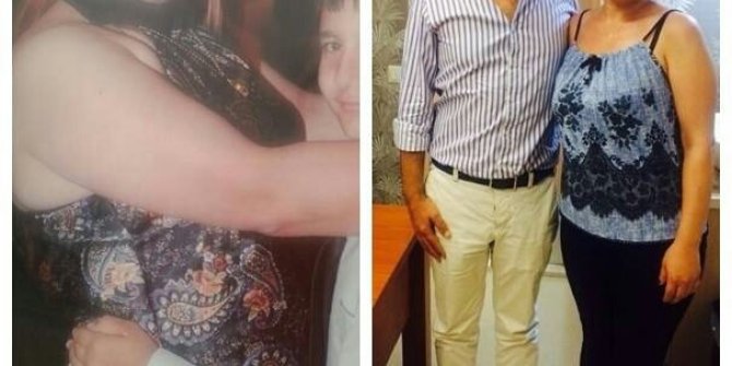 Tüp mide ameliyatıyla 6 ayda 123 kilodan 83 kiloya düştü