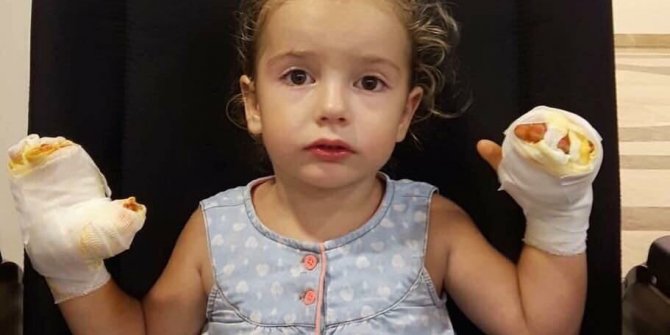 İçinde yanıcı gaz bulunan uçan balon küçük kızı yaktı