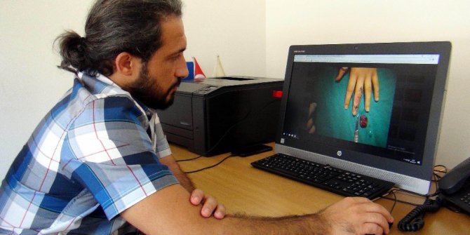 El cerrahları zamanla yarışıyor