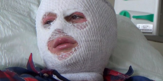 Patlayan parfüm şişesi yüzünü yaktı