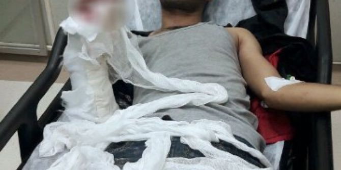 Elinde Bomba Patlayan Şüpheli Hastanede Gözaltına Alındı