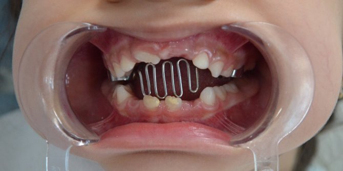 “Parmak Emme Alışkanlığında Erken Tanı Çok Önemli”