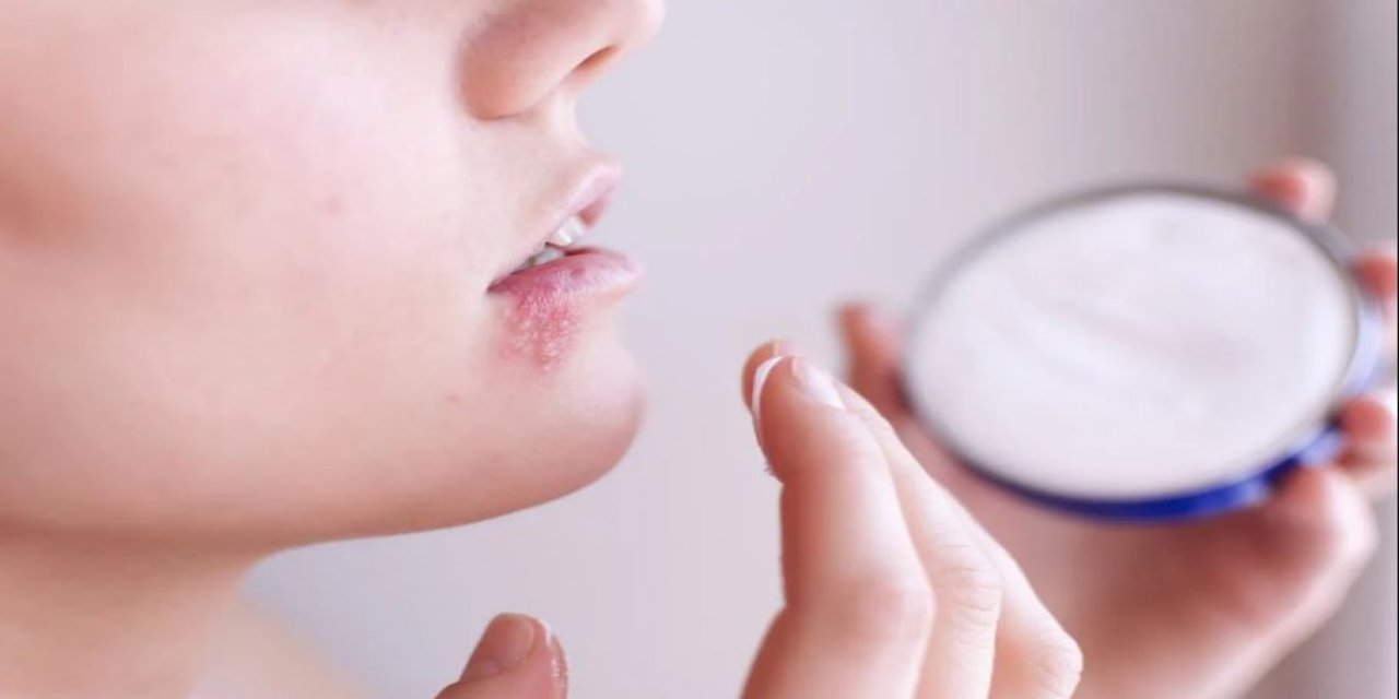 Uçuk Sanılan Dudak Yarası Kanser Çıktı