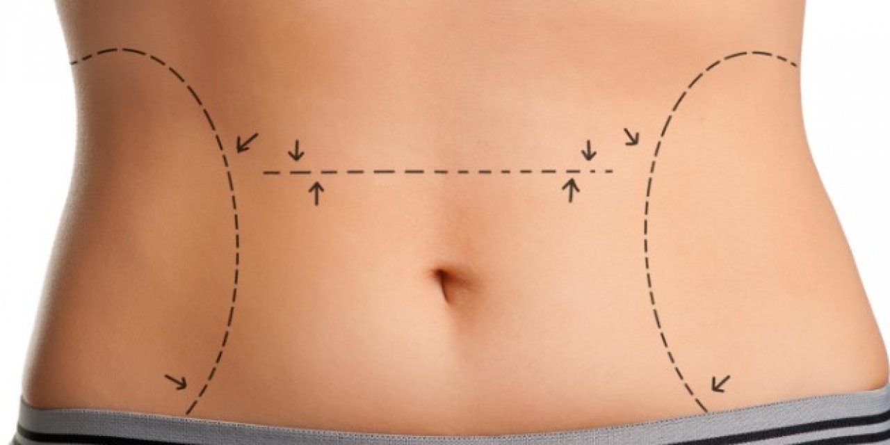 Liposuction Zayıflama Yöntemi Değildir!