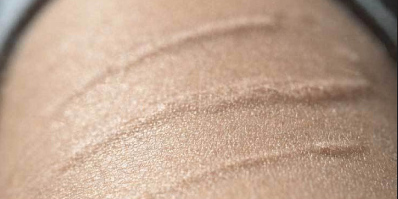 Yara Ve Ameliyat İzlerinin Tedavisi Mümkün Mü?