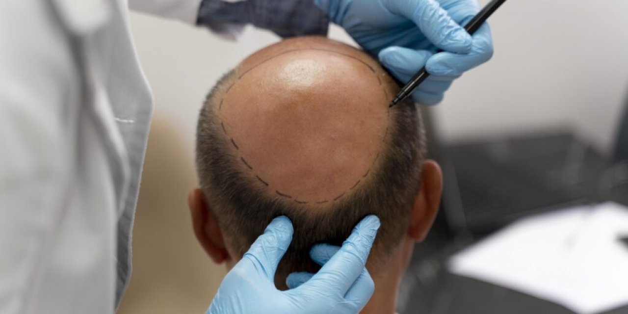 Saç Ekimi Sonrası Bu Kurallar Hayati Önem Taşıyor