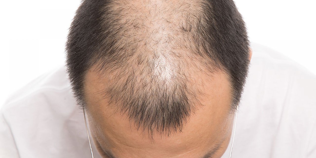 Erkeklerde Genetik Saç Dökülmesi Nasıl Önlenir?