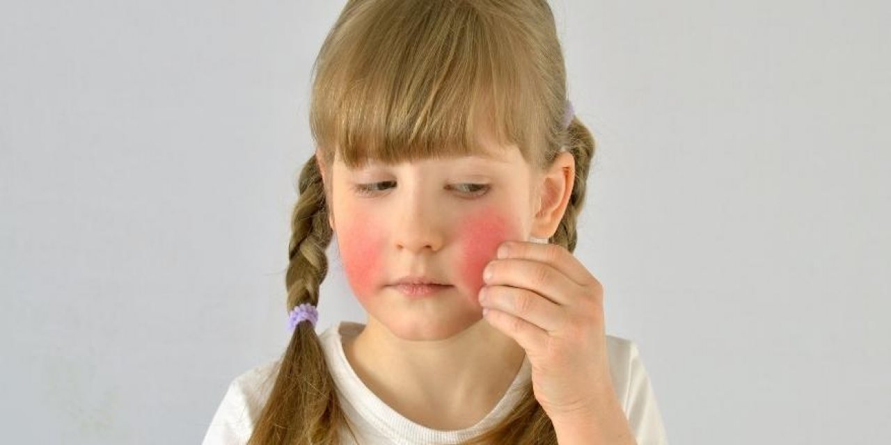 Besin Alerjisi Farkındalık Haftası Başladı