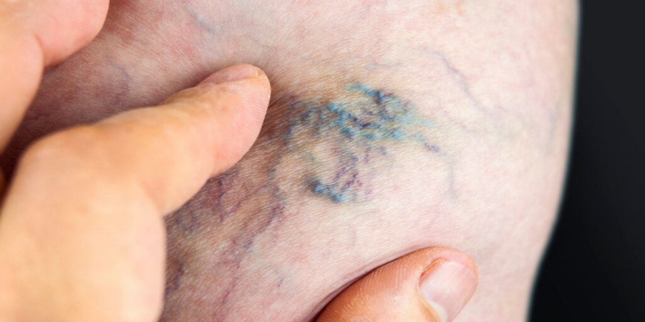 4 Kişiden Birinin Ölüm Sebebi Tromboz