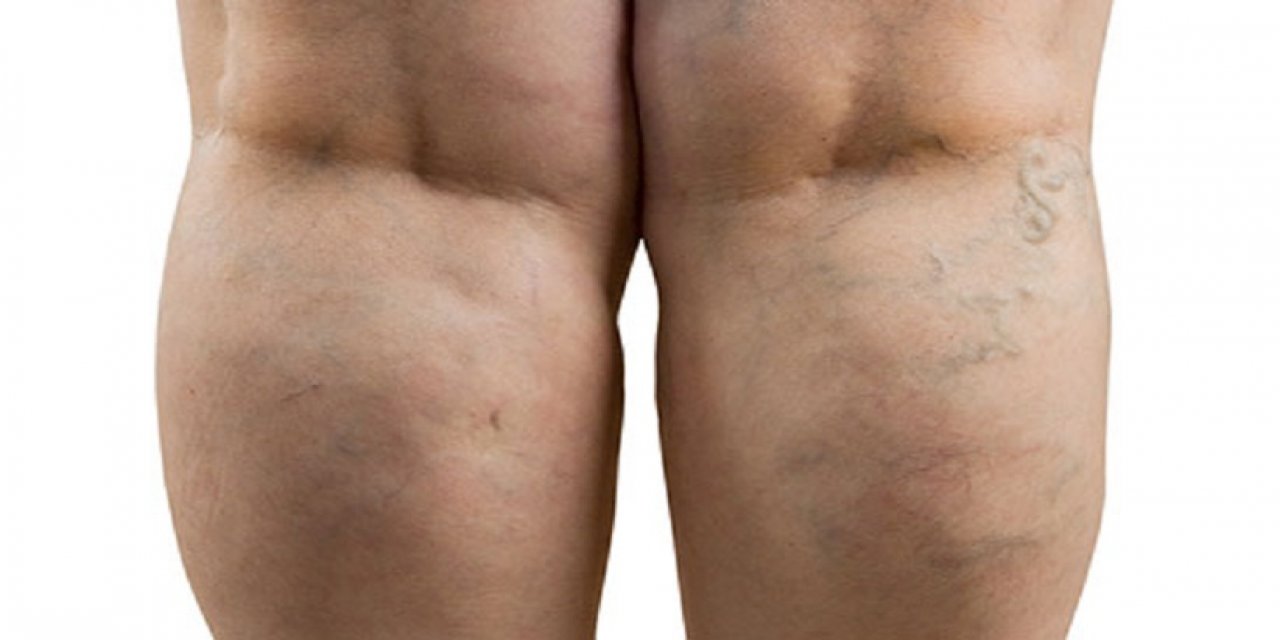 Varis Pıhtı Yapar Mı ?