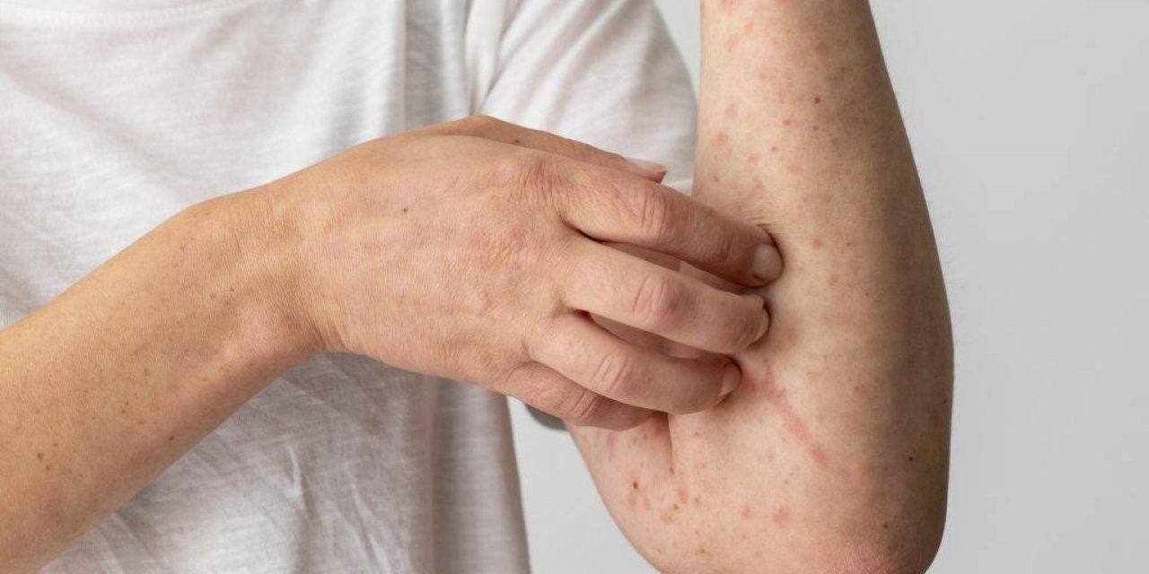 Kene Isırığı, Kırmızı Et Alerjisi Yapıyor