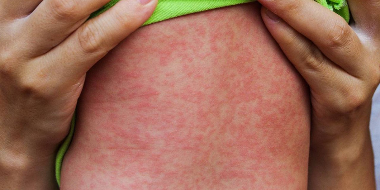 “kızamık Vakalarında Artış Var, Ölüm İddiaları Asılsız!”