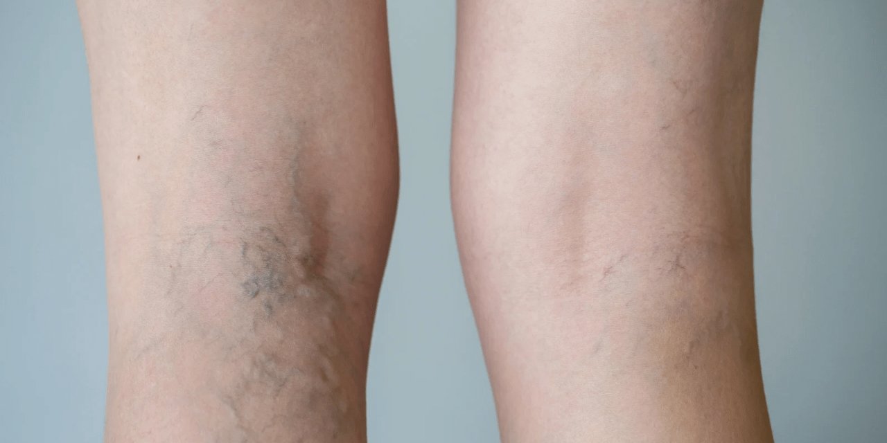 Varis Tedavisinde Masaj Uygulaması Nasıl Yapılmalı?