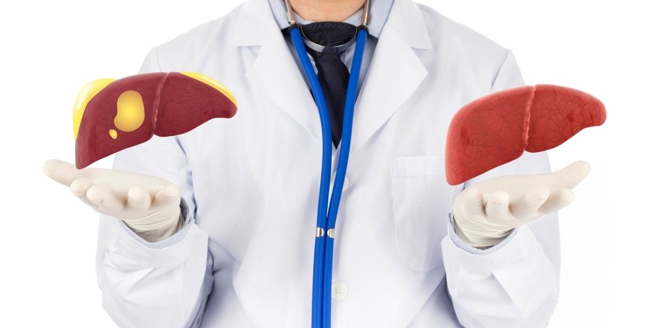 Karaciğer Yağlanmasının Önüne Nasıl Geçilir ?