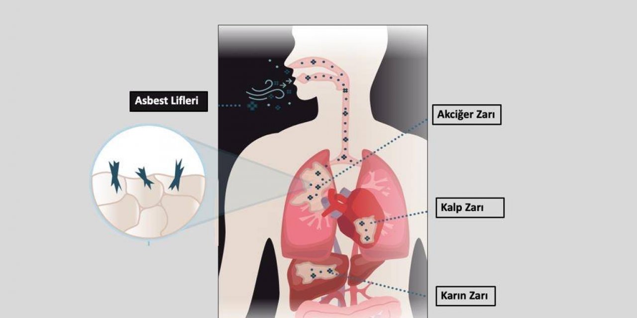 Mezotelyoma Hastalığı Nedir ?