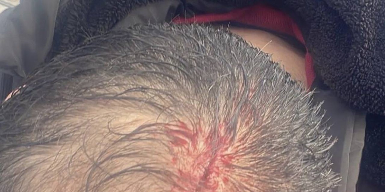 Dersanede Hakkını Arayan Öğretmenin Suratına Kaynar Su Döktüler !