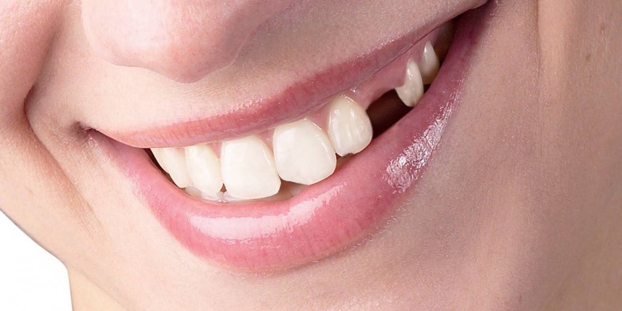 Diş Sağlığında Ömür Boyu Koruma İçin İpuçları