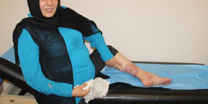 Bacaklarını Kaybetme Korkusu Yaşayan Kadın, Radyo Frekans Yöntemiyle Sağlığına Kavuştu