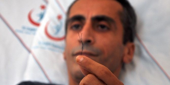 Karın Ağrısı İle Gittiği Hastanede Bağırsağında 2 Tane 10 Santimetre Tel Çıktı