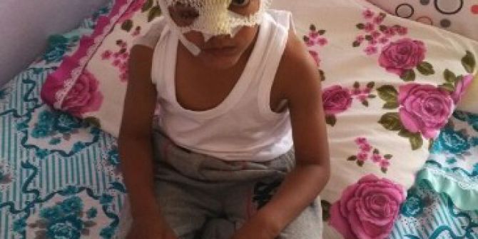 Evinin Önünde Oynarken Köpeğin Saldırısına Uğradı