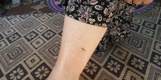 Kuduz Kedinin Saldırdığı Kadın Hastanelik Oldu