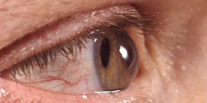 Gözlerini Ovuşturanlar Dikkat