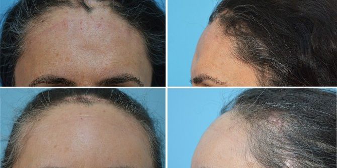 Kayseri Eğitim Ve Araştırma Hastanesinden Kayseri’de İlk Uygulama