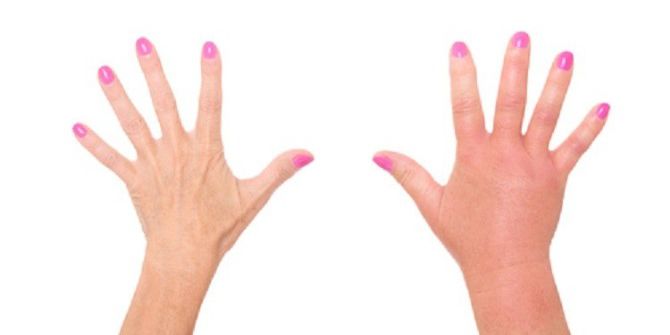 Ödem Yapan Besinlere Dikkat