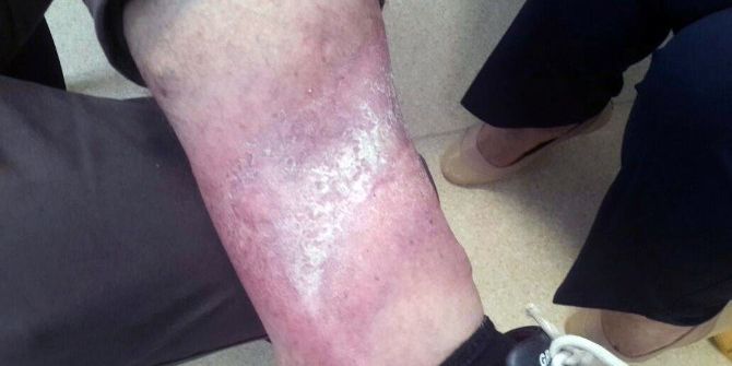 Zayıflayınca 9 Yıllık Varis Yarası Kapandı