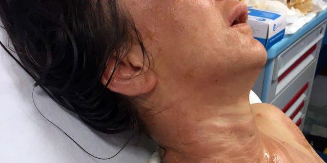 Kaynananın Gelinini Kızgın Yağ İle Yaktığı İddiası