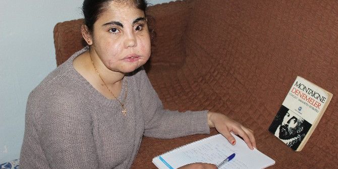 Türkiye’nin Yüz Nakli Yapılan İlk Kadını Hayatını Kaybetti