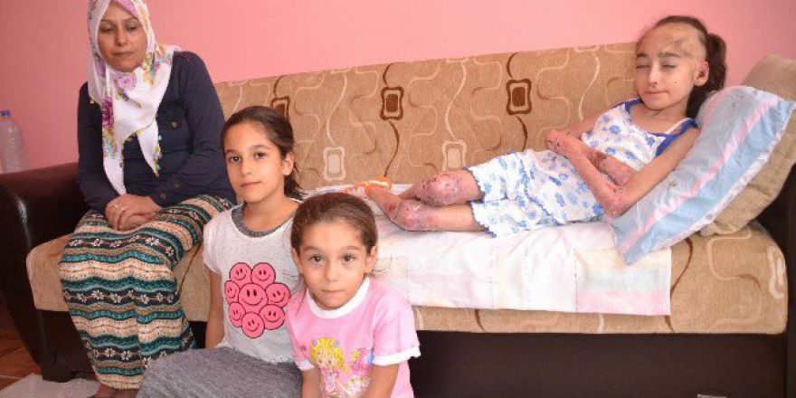 Epidermolizis Bülloza Hastası Merve Yardım Bekliyor