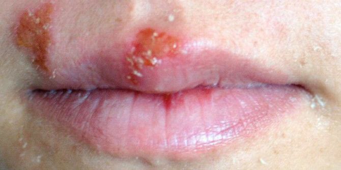 Uçuk Olan Bölgeye Dokunmayın