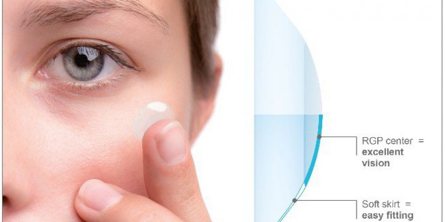 Keratokonus Tedavisinde Kontakt Lens Kullanımı