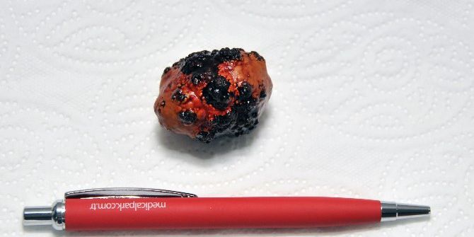 Mesanesinden 4 Cm’lik Taş Çıktı