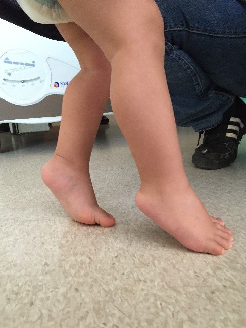 Çocuğunuzun Parmak Ucunda Yürümesi Hastalık Habercisi Olabilir