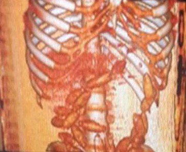 Sindirim Sistemlerinden Uyuşturucu Çıktı