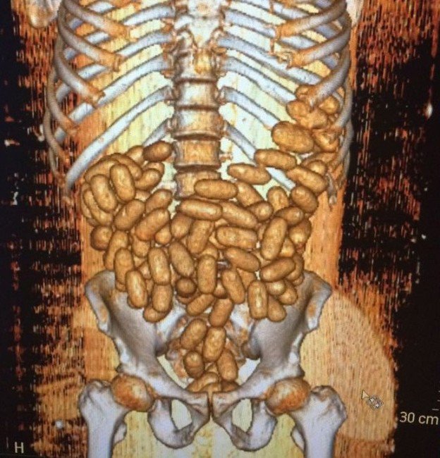 Sindirim Sistemlerinden Uyuşturucu Çıktı