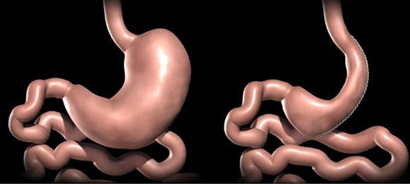 Türkiye’de Her Altı Yetişkinden Biri Obez