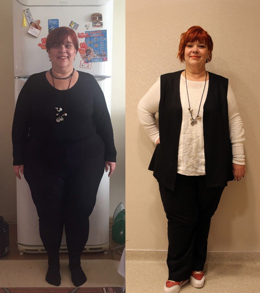 Tüp Mide Ameliyatıyla Artık Daha Sağlıklı