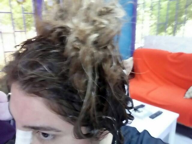 Yanlış Yıkama Ve Kimyasal Yüzünden Saçından Oldu İddiası