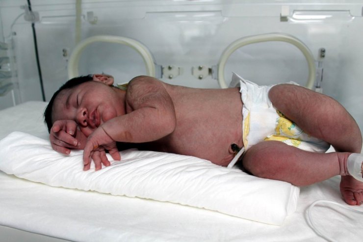 Annede folik asit eksikliği bebekte ölüm riski
